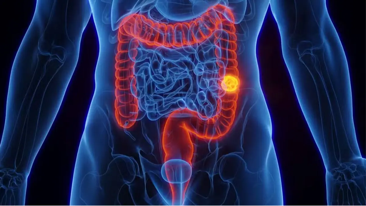 SUS passa a incluir exame imunoquímico fecal para rastreamento do câncer colorretal